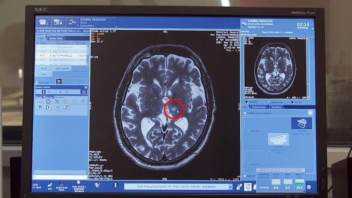 Un écran montre l'intérieur du crâne d'un homme. 