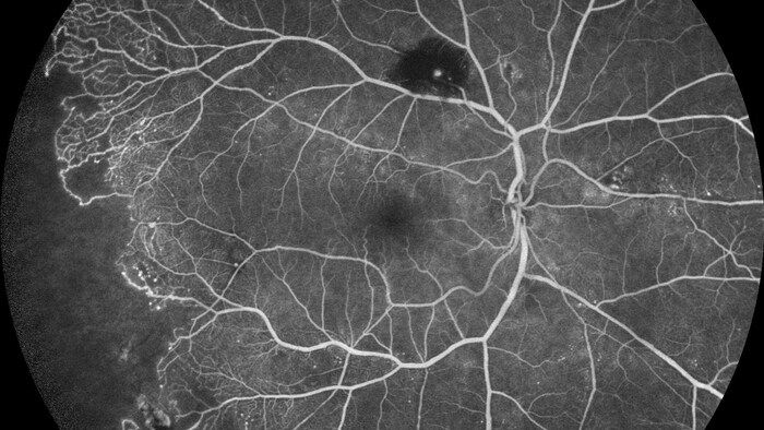 Le fond de l'oeil est représenté avec ses fins vaisseaux sanguins.