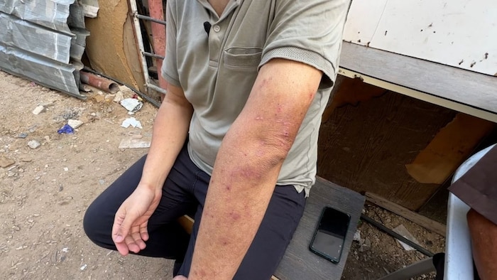 Al Serr said while detained in Israeli custody, his arm was covered in pus-filled bumps that he was not allowed to be treated for. He said he treated it with a "cheap cream" immediately after he was released and the reaction began to wane. 