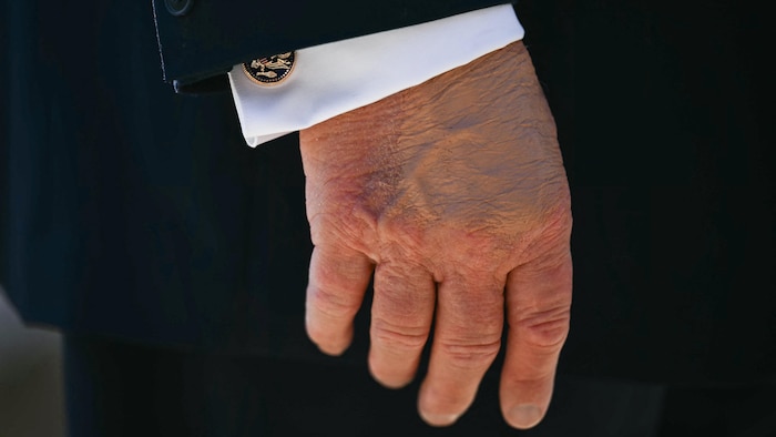 Gros plan de la main droite de Donald Trump, maquillée de façon à camoufler une marque.