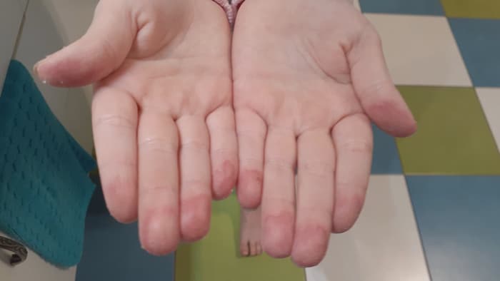 COVID-19 : surveillez les blessures aux mains de vos enfants ...