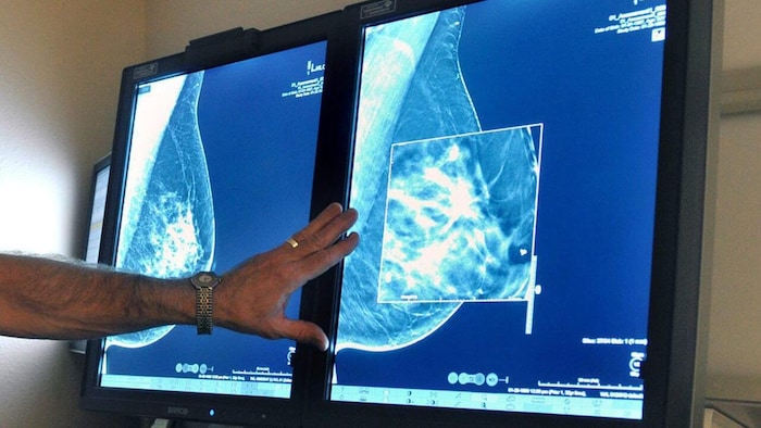 Une radiographie d'un sein.