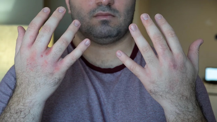 Mohammed Tisir Otahbachi montre ses mains sur lesquelles se trouvent de petites cloques.
