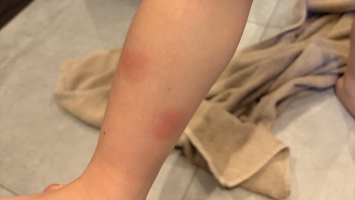 Piqûres sur une jambe d'enfant.