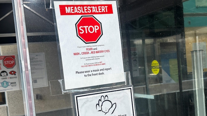 Sur la porte vitrée d'un hôpital, une affiche donne de l'information sur la marche à suivre en cas de rougeole, avec un dessin de panneau d'arrêt-stop rouge et les mots « Measles Alert ».