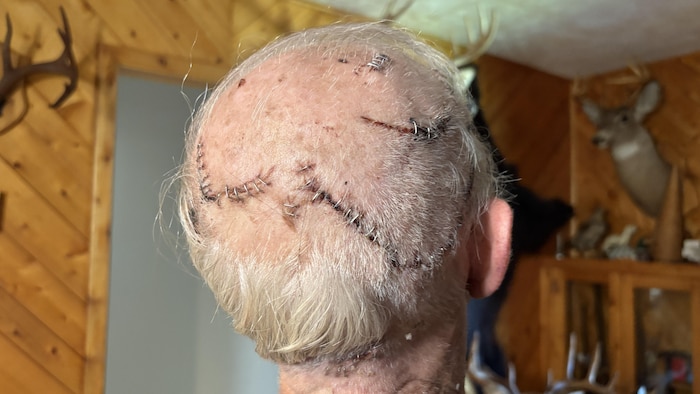 Les blessures sur le crâne de Serge Guitard.
