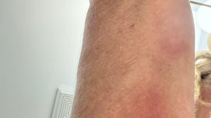 Un bras avec des contusions.