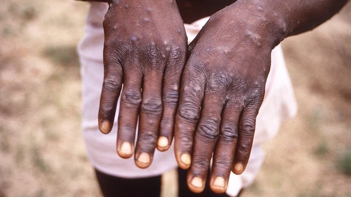 Des éruptions cutanées sur les mains d'un homme.