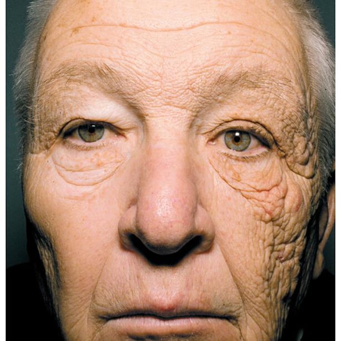 Sur le côté droit de son visage, l'homme a très peu de rides. Sur son côté gauche, il a des rides très profondes.