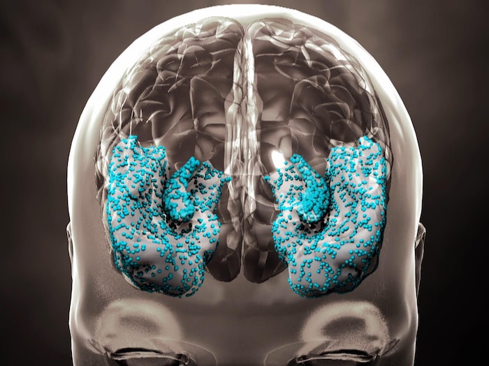 Représentation du cerveau montrant la progression de la maladie d'Alzheimer
