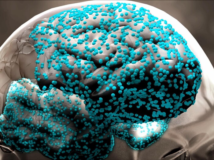 Représentation du cerveau montant la progression de la maladie d'Alzheimer.