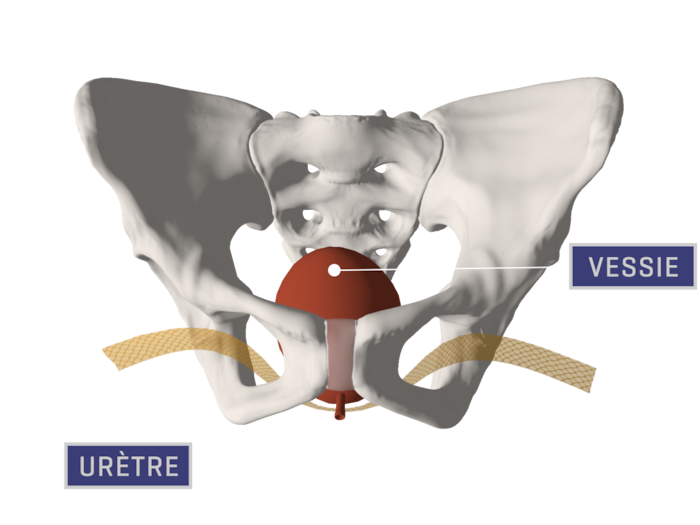 Faire retirer sa bandelette d’incontinence aux ÉtatsUnis RadioCanada