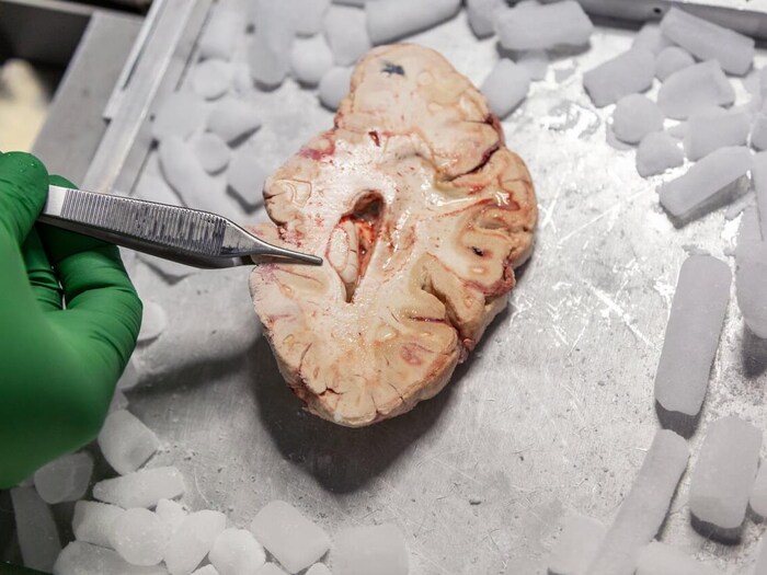 Una mano tiene un bisturi su una fetta di cervello umano.