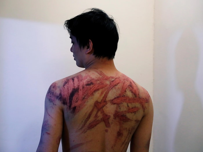 Un homme exhibe son dos couvert de blessures.