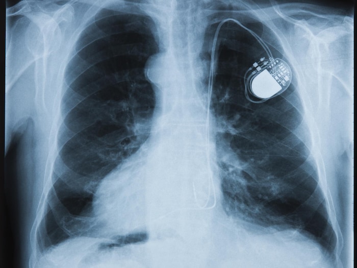 Radiographie montrant un stimulateur traditionnel dans la poitrine d'une personne.