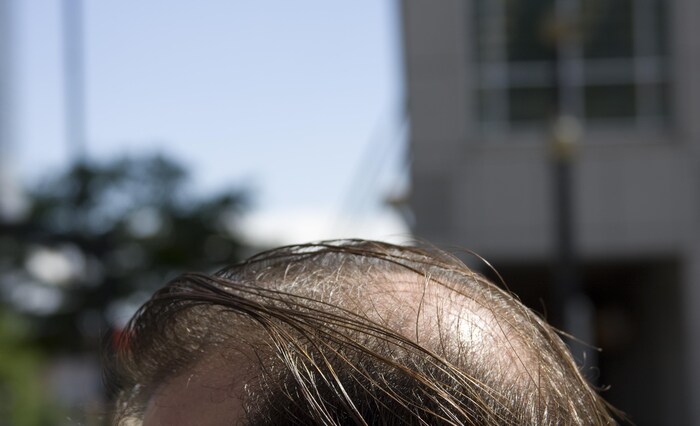 Plan rapproché du sommet du crâne d'un homme. De longues mèches minces, brunes, graisseuses et reluisantes, recouvrent le cuir chevelu partiellement dégarni et clairsemé de quelques poils grisonnants.