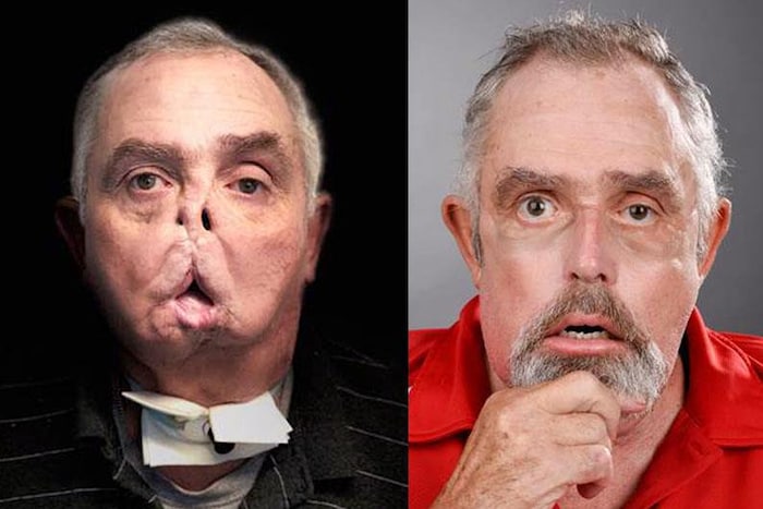 Images d'un homme avant et après une transplantation du visage.