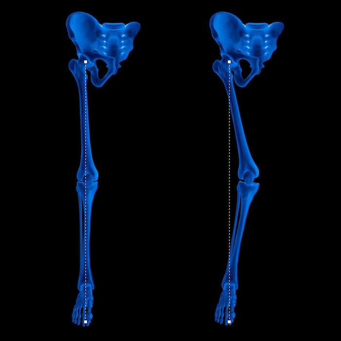 Image de deux rayons X de jambes humaines, l'une à morphologie normale, l'autre montant un genou entré vers l'intérieur.