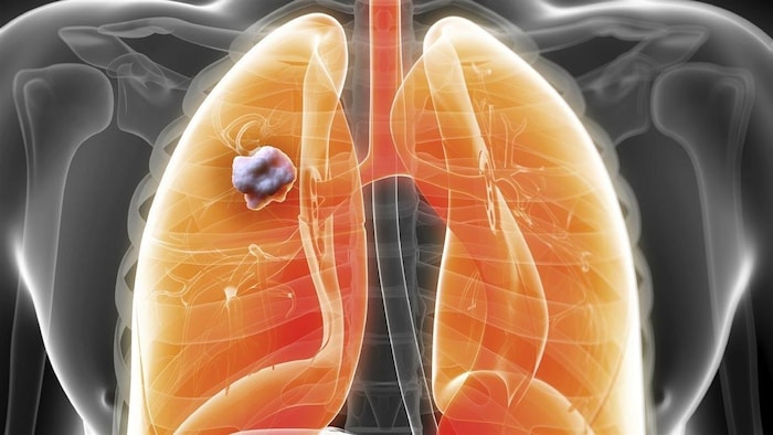 Modélisation par ordinateur de poumons atteints d'un cancer.