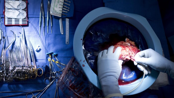 Un médecin insère un tube dans un rein.