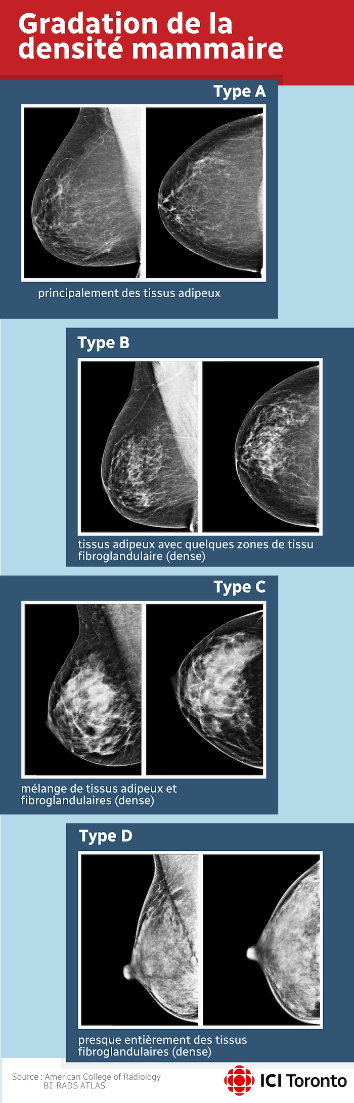Quatre types de mammographies avec, determination chaque type, deux photos de seins. On voit sur les images la proportionality de tissus adipeux et de tissus fibroglandulaires (dense).