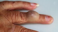 Tout Ce Que Vous Devez Savoir Sur Les Kystes Souvent B nins OHdio Tout Ce Que Vous Devez Savoir Sur Les Kystes Souvent B nins OHdio
