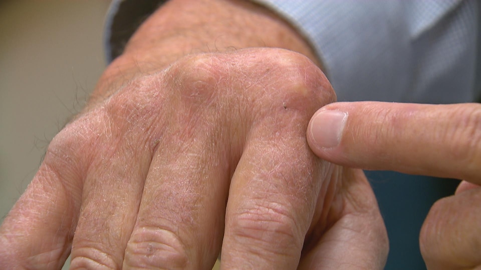 Un homme souffrant d'arthrite rhumatoïde