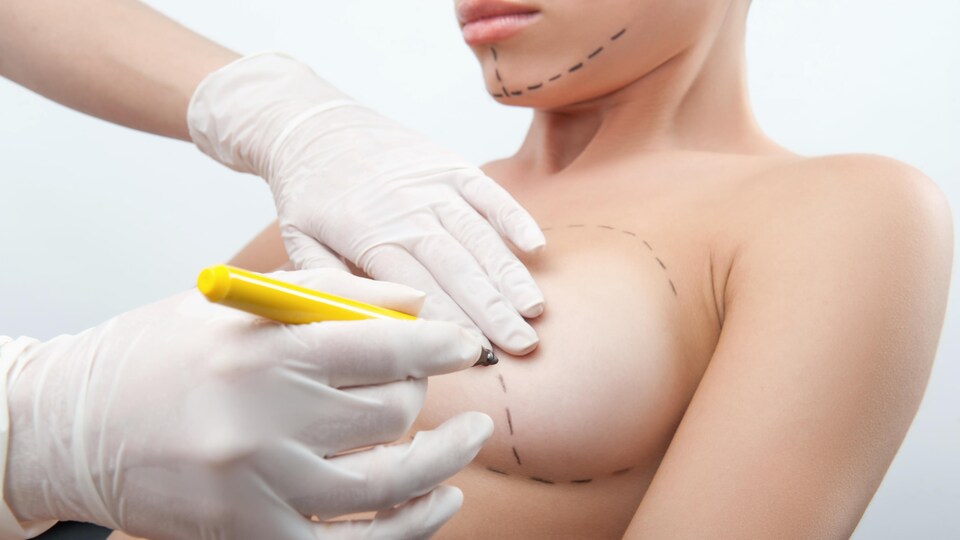 Une femme nue se fait marquer par un chirurgien.