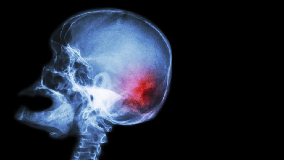 Rayons X d'un cerveau lors d'un accident vasculaire cérébral (AVC), représenté par une zone rouge.