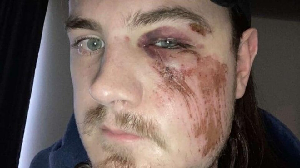 Un homme avec des blessures au visage.
