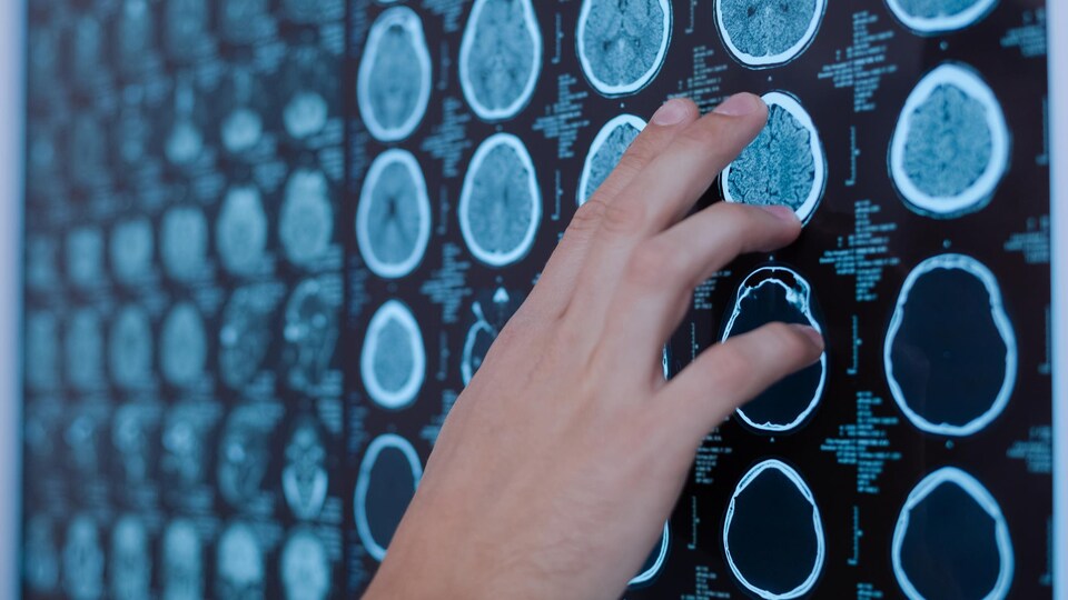 Un docteur pointe une image de cerveau. 
