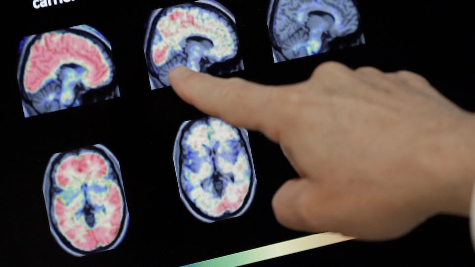 Imagerie médicale du cerveau, communément appelée PET scan, sur un écran d'ordinateur d'un institut de recherche sur l'Alzheimer, à Phoenix en Arizona le 14 août 2018.