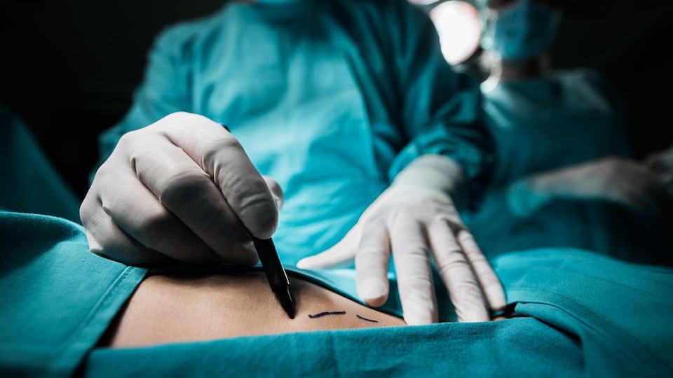 Un chirurgien plastique portant des gants effectue des lignes sur le corps d'un patient.