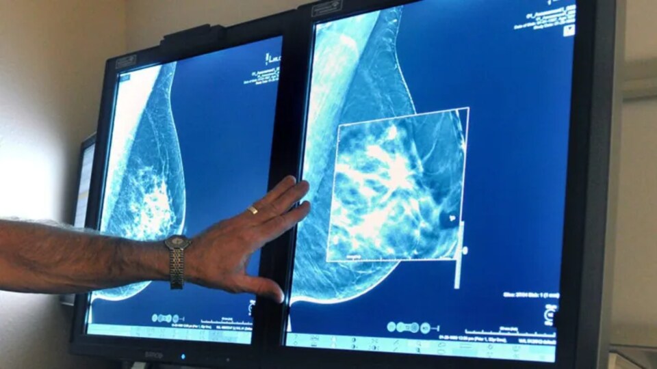 Un cancer du sein sur un écran.