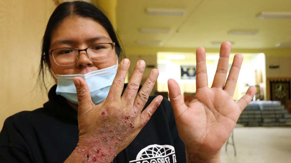 Une femme montre ses mains couvertes de plaies causées par l'eczéma.