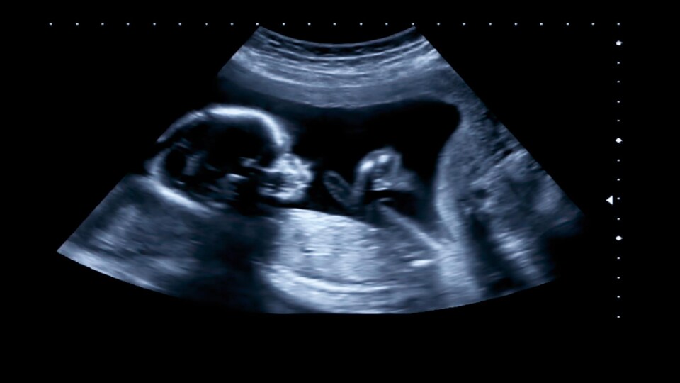 Échographie d'un fœtus au quatrième mois.
