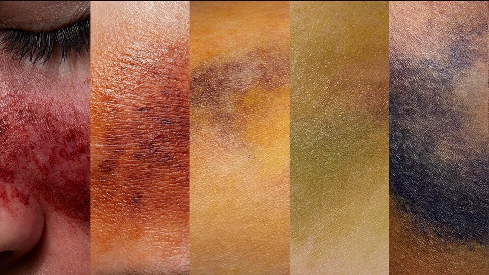Un arc-en-ciel composé de différentes images de peau couverte d'ecchymoses de différentes couleurs.