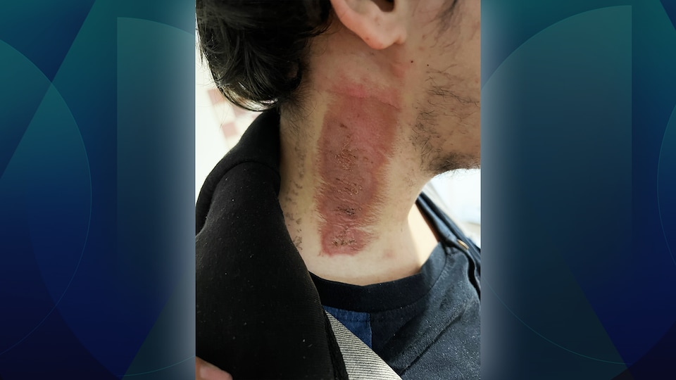 Un jeune homme avec des blessures au cou.