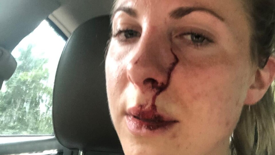 Erin McKenzie avec une importante griffure à côté du nez.
