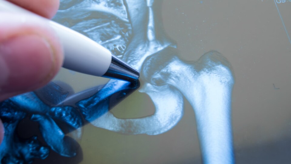 Une radiographie de la hanche
