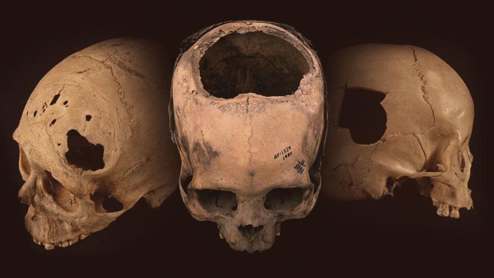 Des crânes perforés lors d'une chirurgie