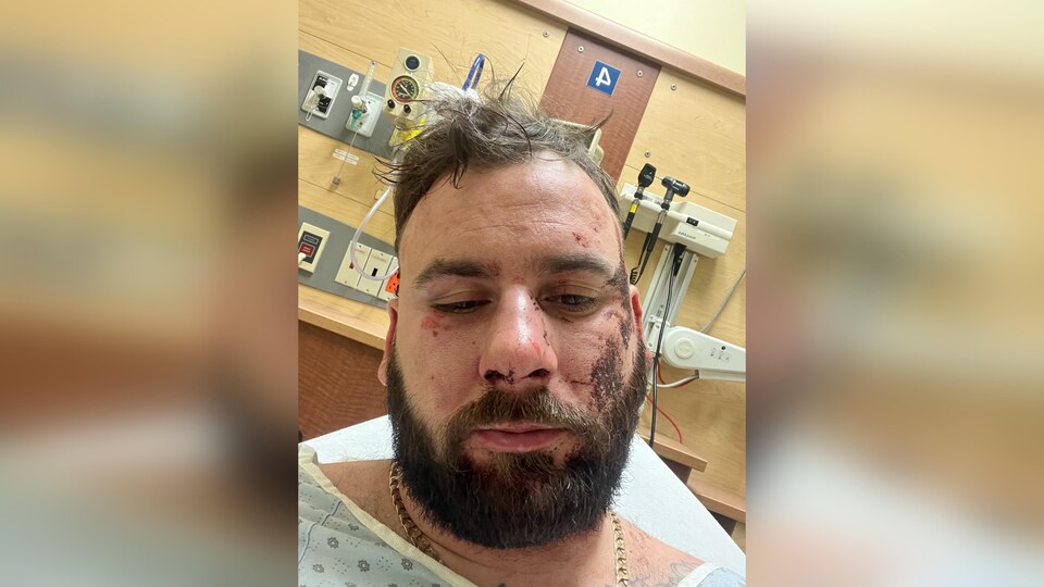 Les blessures sur le visage de l'homme à l'hôpital à la suite de l'intervention des policiers.