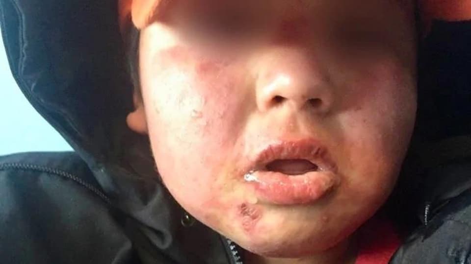 Un garçon avait des éruptions cutanées sur son visage.