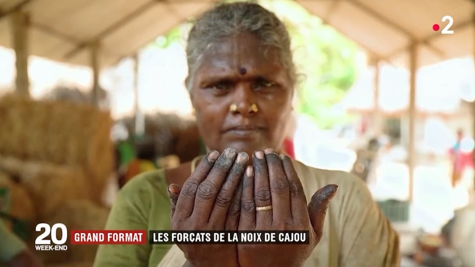 Hintli bir kadın yanmış parmaklarını gösteriyor.