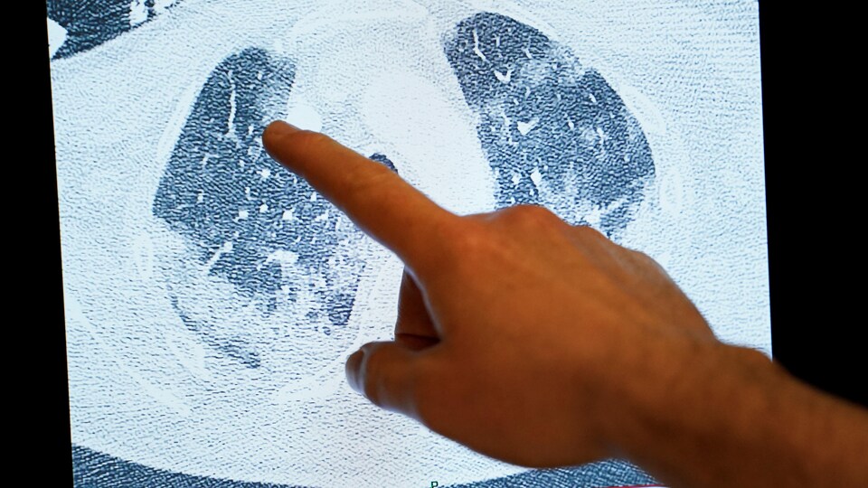 Un médecin montre une radiographie des poumons d'un patient atteint de la COVID-19.