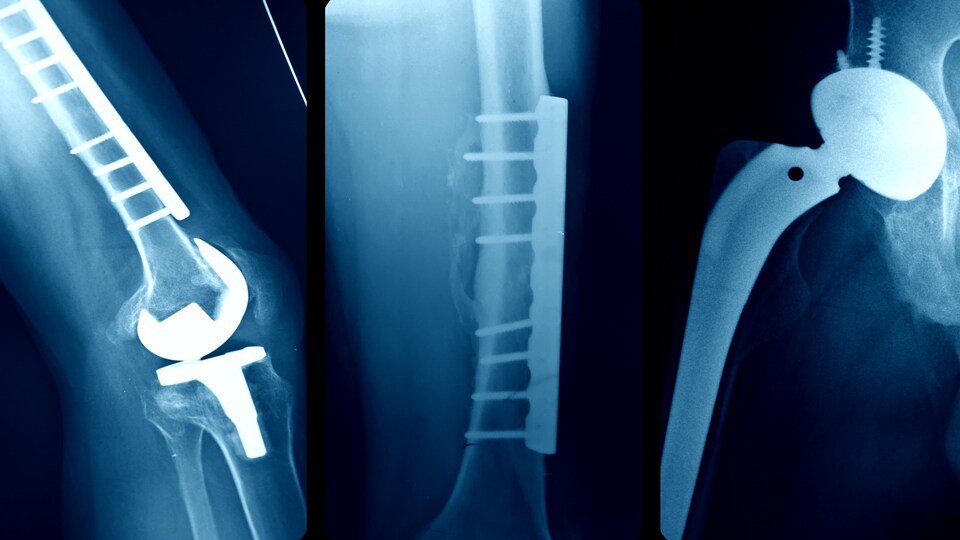 Des radiographies de dispositifs médicaux implantés chez des patients.