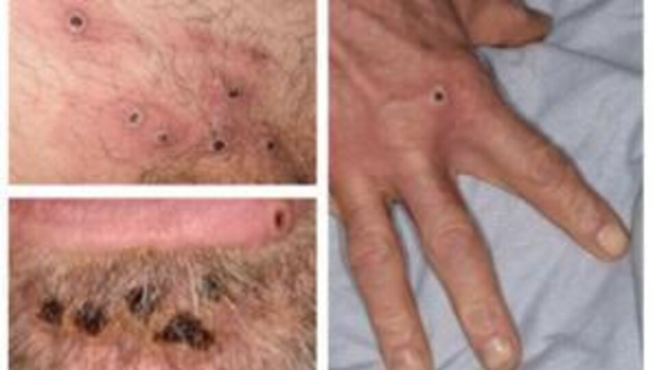 Des lésions cutanées associées à la variole simienne.
