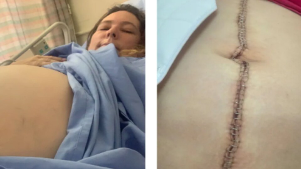 Photographies d'une femme sur son lit d'hôpital, l'une avec le ventre tout gonflé, l'autre avec les agrafes sur son ventre après la chirurgie