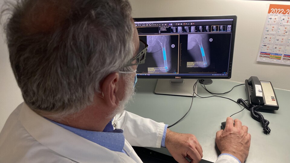 De dos, le docteur Robert Turcotte regarde sur un écran d'ordinateur une radiographie sur laquelle apparaît en bleu le dessin de l'implant métallique qui sera intégré au fémur de Pierre Marinier.
