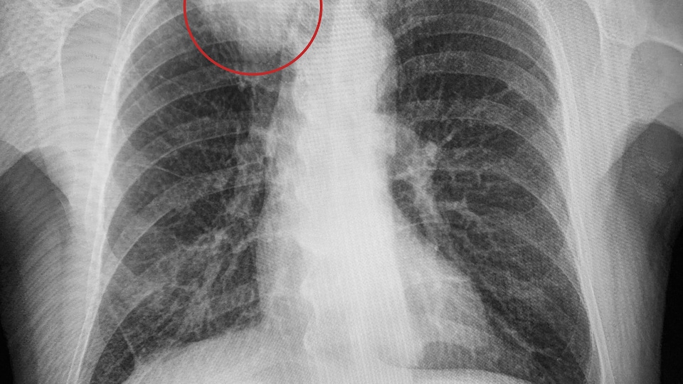 Un homme atteint de cancer poursuit son médecin pour retard de ...